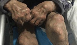 痛风吃角瓜行吗,角瓜的食疗作用解析